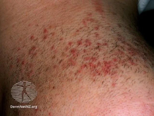 https://thegroomingdoc.com/wp-content/uploads/2026/01/1b453-folliculitis11__watermarkedwyjxyxrlcm1hcmtlzcjd5b15d.webp
